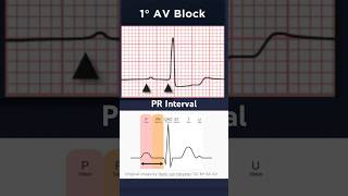 ECG Basics PR Interval [upl. by Gisele190]