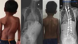 Dr Thomas Kishen  Shilla technique for management of scoliosis in a 6 Year Old [upl. by Kitti214]