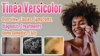 Tinea versicolor overview causes sign and symptoms diagnosis treatment home remedies and FAQs [upl. by Essa336]