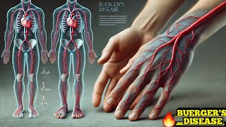 Buergers Disease Thromboangiitis Obliterans Easy Explanation [upl. by Mcgraw]