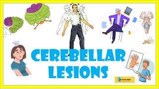 Cerebellar lesionsexamination signs lesions and ataxic gait heel knee shin test [upl. by Lothair865]