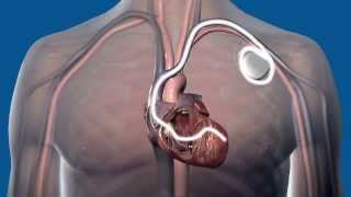 What is Cardiac Resynchronization Therapy CRT and how does it work [upl. by Estes]