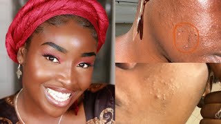 I RUINED MY SKIN  How I used Differin and Tetralysal to clear my skin again [upl. by Ytinav]