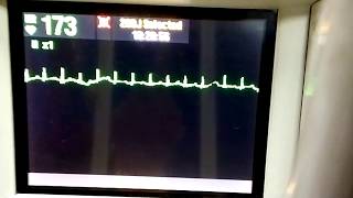 Adenosine diagnostic test during SVT [upl. by Albarran]