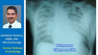 Pulmonary Edema on CXR [upl. by Nalrah]