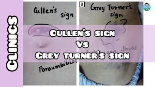 Cullen’s vs grey turner’s sign  explained in less than 1 minute for USMLE [upl. by Karlise711]