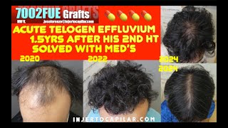 7002Grafts NW V 2HT 274 amp 269hgraft TDC20k Telogen effluvium 15 yrs after 2nd HT25932021 [upl. by Vod]