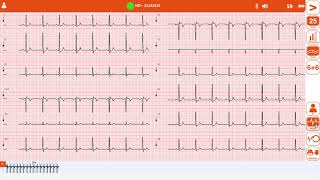 Acquisizione tracciato Ecg con elettrocardiografo Cardioline touch Ecg HD Plus [upl. by Amyaj336]