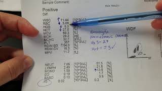 Hematology How to interpret automated Complete Blood Count CBC results [upl. by Timothy]