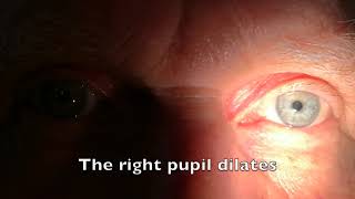 Relative afferent pupillary defect RAPD [upl. by Rebak56]