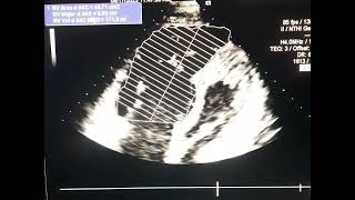 ARVC  ARVD  classical echocardiography study [upl. by Galatea]