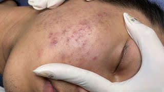 ACNE TREATMENT VU QUYNH MI Acne On Teens Cheek 2024 [upl. by Tera]