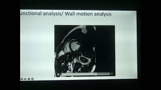 Lecture 16 Ischemic cardiomyopathy [upl. by Ansaev84]