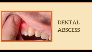 Understanding Dental Abscess Causes Symptoms and Treatment shorts youtubeshorts [upl. by Mroz]