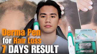 7 DAYS OF USING MINOXIDIL AND DERMA PEN FOR HAIR LOSS  GRABE TO [upl. by Annayi871]