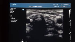 Thymus Gland Sonography [upl. by Arihk]