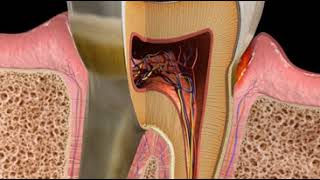 Abscess Periodontal [upl. by Aivatnwahs475]