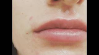 Lip Injections Long Lasting Juvederm Voluma for that quotWOWquot Lip Look by Dr Lebowitz New York [upl. by Jaenicke]