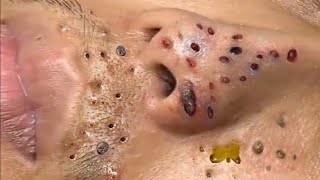 Blackhead Removal With Sac Dep Spa 10006943 [upl. by Story]