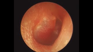 Glomus tympanicum middle ear paraganglioma [upl. by Atnuhs]