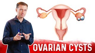 Ovarian Cysts Causes Symptoms amp Natural Treatment – DrBerg [upl. by Christis]