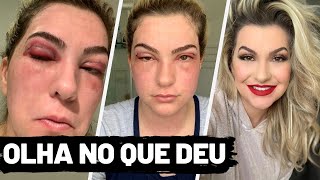 TUDO SOBRE MINHA BLEFAROPLASTIA TIREI AS BOLSAS E PELANCAS DOS OLHOS POR ALICE SALAZAR [upl. by Kahcztiy]