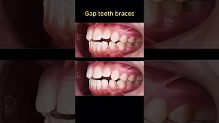 26 month braces braces orthodontist dentist dentistry dental [upl. by Melton]