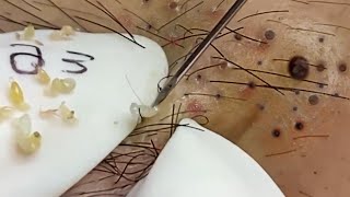 Removal Hidden Blackheads At Loan Nguyen Spa  14 [upl. by Nahtahoj]