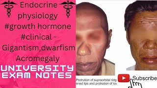 Growth hormone clinicalgigantismacromegalydwarfismmedicoscontent3135 [upl. by Bellina]