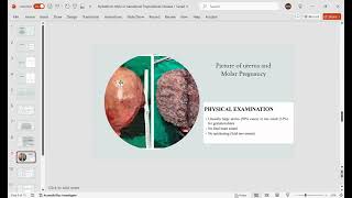 Hydatiform mole or Gestational Trophoblastic Disease [upl. by Snodgrass]