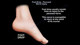 Foot Drop peroneal nerve Injury [upl. by Drummond]