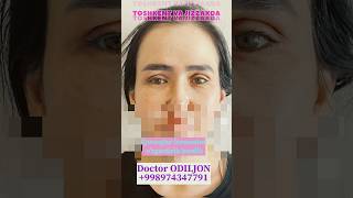 Qovoq olish  қовоқ олиш  blefaroplastika Doctor ODILJON 998974347791 TOSHKENT VA JIZZAXDA rek [upl. by Suzan]