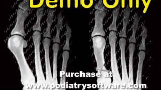 Foot Surgical Animations Part 1 [upl. by Atteloc]