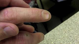 Finger Nail Deformity  Mild Spoon Nails [upl. by Sillihp465]