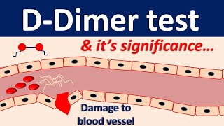 Ddimer test and its significance [upl. by Tuinenga]