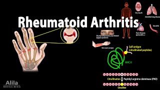 Rheumatoid Arthritis Animation [upl. by Nais]