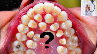 MORE THAN 500 TEETH I Hyperdontia I Gardner syndrome supernumerary teeth ISabaceous Cysts [upl. by Leind]