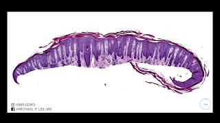 Psoriasis versus nummular dermatitis Dermpath made easy [upl. by Cenac]