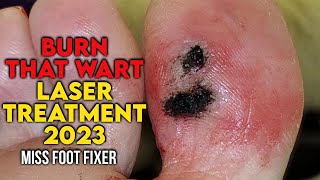 quot BURN THAT WART quot LASER TREATMENT FOR FOOT WART 2023 BY FOOT SPECIALIST MISS FOOT FIXER [upl. by Catt653]