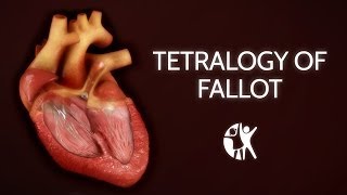 Tetralogy of Fallot  TOF Echo [upl. by Kirt643]