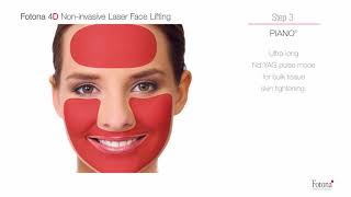 Fotona 4D NonInvasive Laser Facelift [upl. by Ylrevaw]