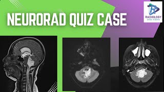 quotCrack the Case Neurorad Quiz Challengequot  Dr Umamaheswara Reddy V [upl. by Bollay]