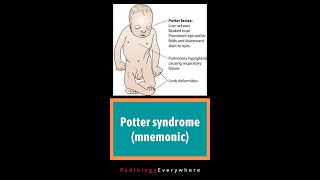 Potter syndrome  mnemonic POTTER  Radiology tutorials  BL renal agenesis  video 48 [upl. by Elsy879]