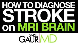 How to Diagnose Stroke on MRI Brain [upl. by Enimrac747]