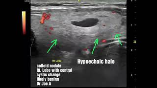 complex colloid nodule with cystic degeneration Rt Lobe [upl. by Atikehs]