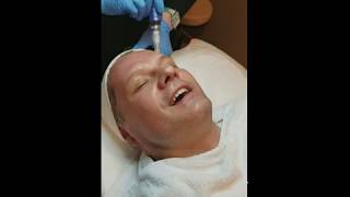 Micro Needling Treatment for Skin Wrinkles [upl. by Beller388]