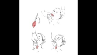 How to Insert a Laryngeal Mask Airway  Merck Manual Professional Version [upl. by Akived]