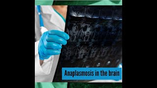 Anaplasmosis causes neurologic problems [upl. by Gilchrist]