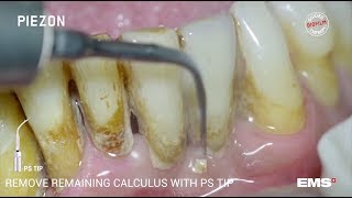 Guided Biofilm Therapy Step 06 Calculus removal with PIEZON® and the PS instrument [upl. by Alo]