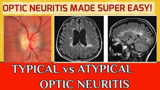 OPTIC NEURITIS  Typical optic neuritis and atypical optic neuritis [upl. by Churchill]